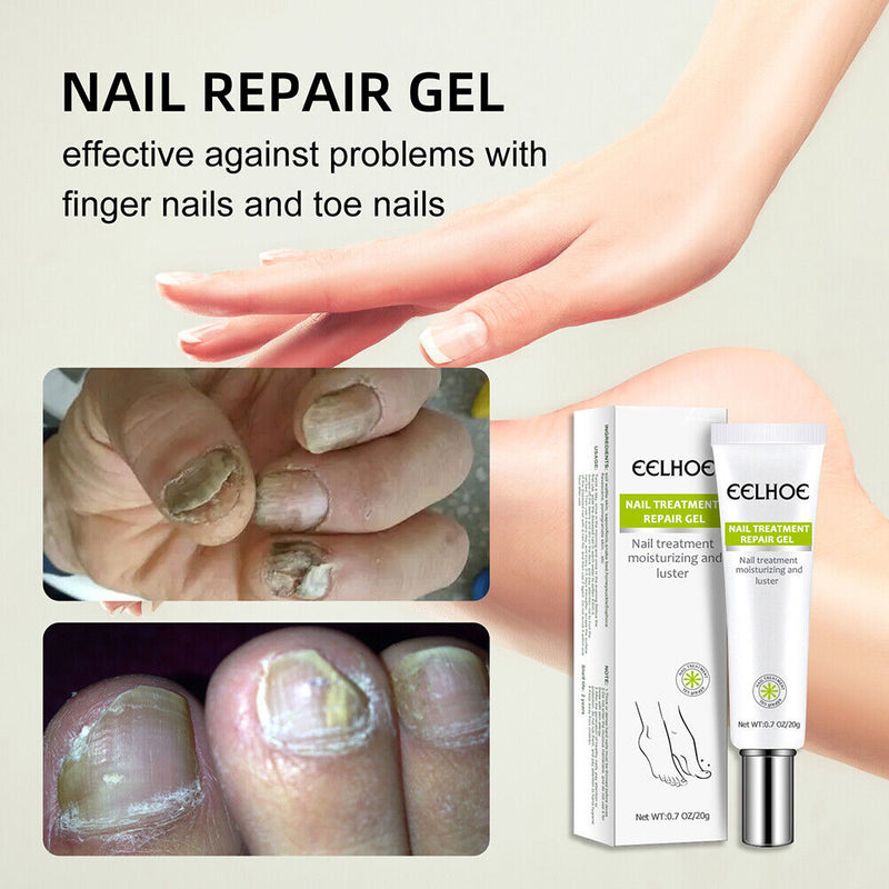 Gel Anti Infection Paronychia Treatment Toe Health Foot Care