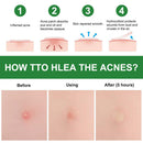 24pcs Ultra-thin Acne Pimple Remover Patches Acne Treatment Stickers Kit Newly