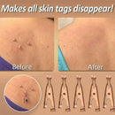 Micro Safe Skin Tag Remover Kit For Fast & Effective XAA Skin Tag 2021 R2V4