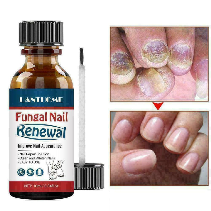 Nail Repair Anti Fungal Nail Infection Onychomycosis ml 10 D7D8 M6G7 M6J4 J8F5