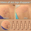 Micro Safe Skin Tag Remover Kit For Fast & Effective XAA Skin Tag 2021 R2V4