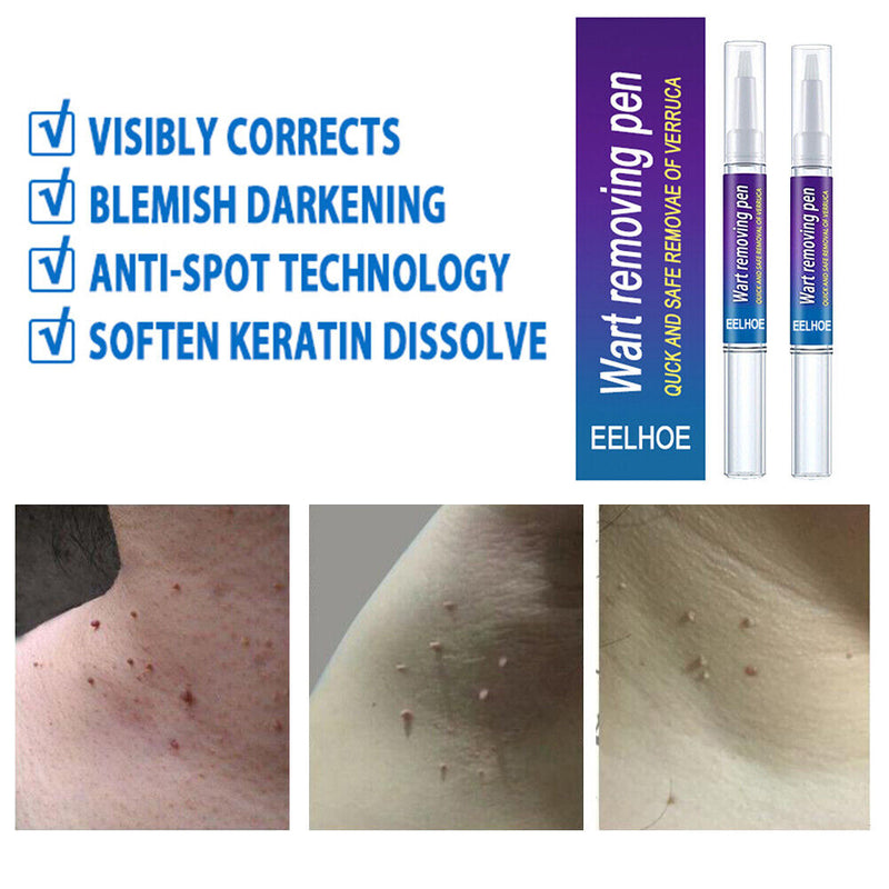 2pcs Wart Remover Skin Tag Pen Safe Herbal Ingredients Medicine Ointment Tools