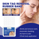 Rubber Skin Tag Remover Device Painless Safe Easy To Use Face Care Beauty Tools