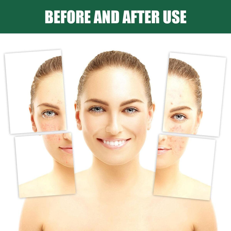 Wormwood Soap Anti-fungal Anti-itch Mites Acne Bath Soap Oil Control.