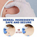 Of Warts Liquid Anti Verruca Remedy Removing Against Moles Warts Remover Pen