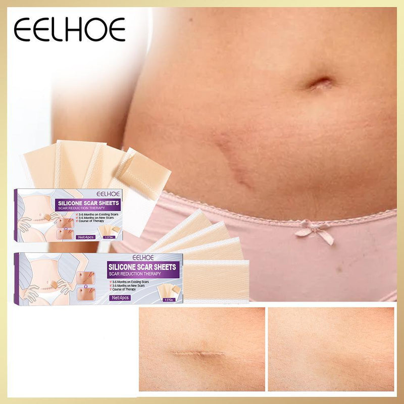 4pcs Silicone Scar Sheets Gel Strips Patch Adhesive Scar Removes (75mm)