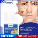 Rubber Skin Tag Remover Device Painless Safe Easy To Use Face Care Beauty Tools