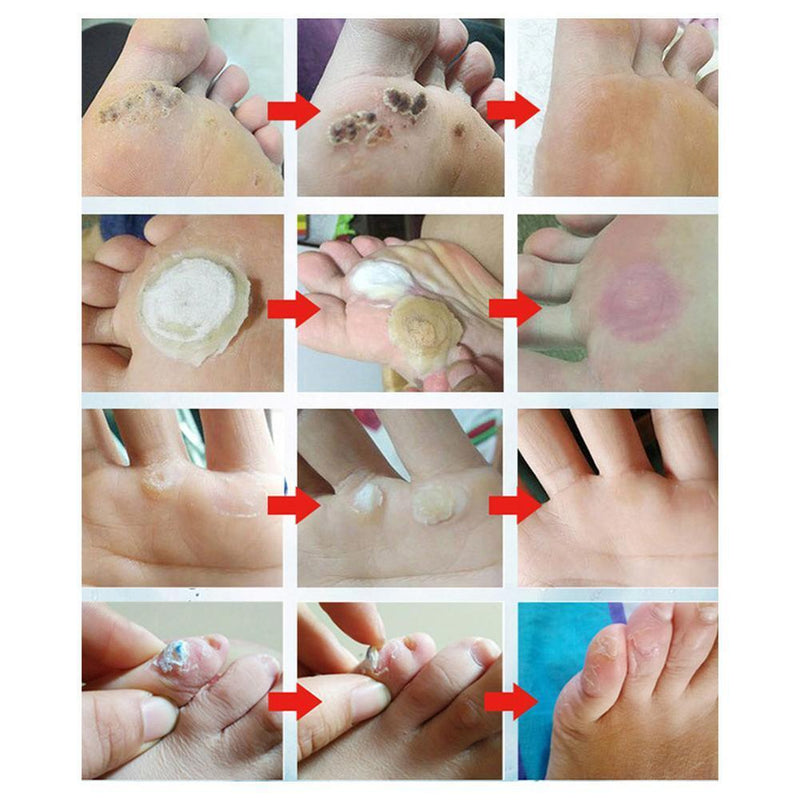 24pcs Feet Warts Remover Pads Foot Callus Corn Stickers Foot Care Plaster