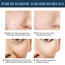 Lift Thread Face Lifting Thread Chin Lift Thread Collagen Silk Thread