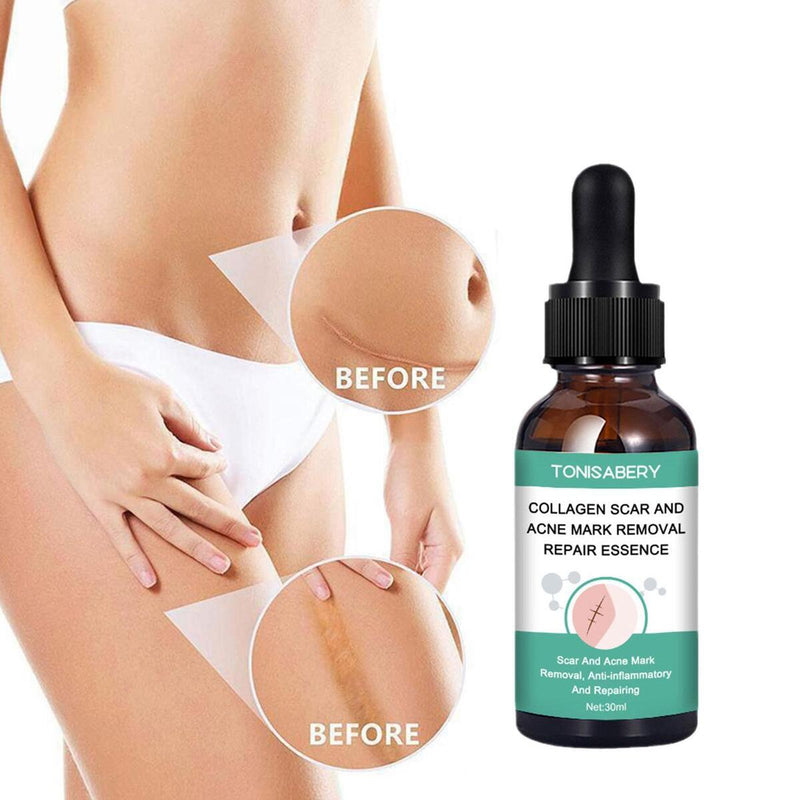 Narbenentfernung Ätherisches Öl Dehnungsstreifen Akneflecken Narbenchirurgie.