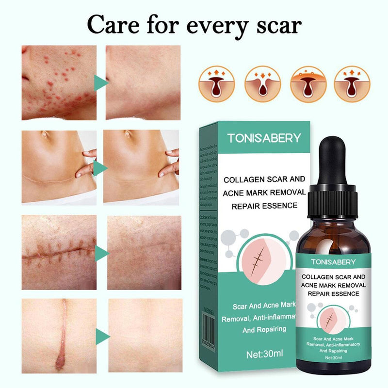 Narbenentfernung Ätherisches Öl Dehnungsstreifen Akneflecken Narbenchirurgie.