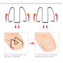 Ingrown Nail Groove Correction Hook Orthosis Paronychia Treatment Clip Corrector