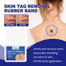 Rubber Skin Tag Remover Device Painless Safe Easy To Use Face Care Beauty Tools