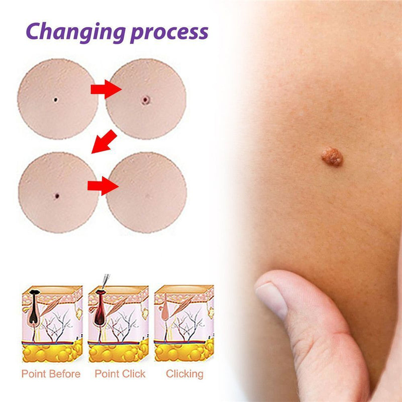 Wart Treatment Liquid Anti Verruca Remedy Warts Remover Removing Against Moles