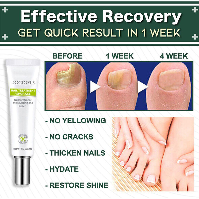 Paronychia Treatment Toe Health Foot Care Anti-Infection Gel