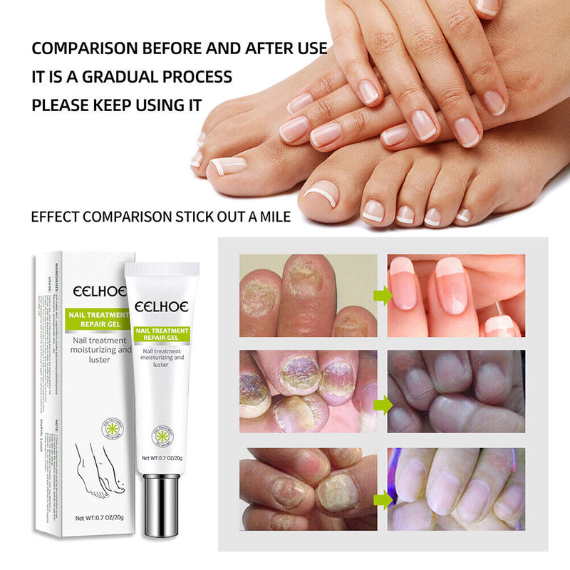 Paronychia Treatment Toe Health Foot Care Anti-Infection Gel
