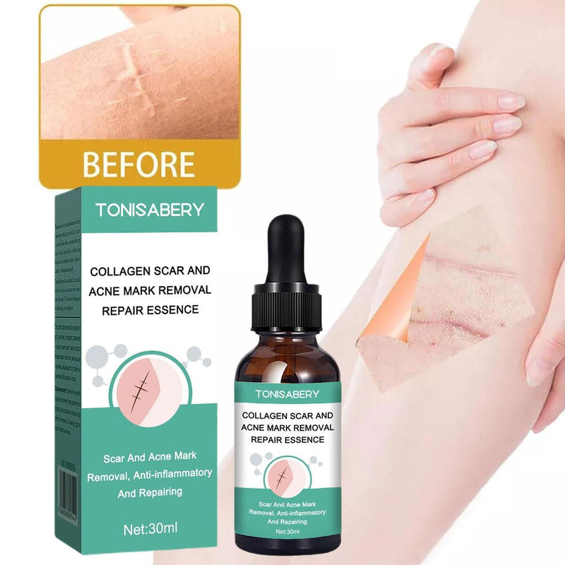 Narbenentfernung Ätherisches Öl Dehnungsstreifen Akneflecken Narbenchirurgie.