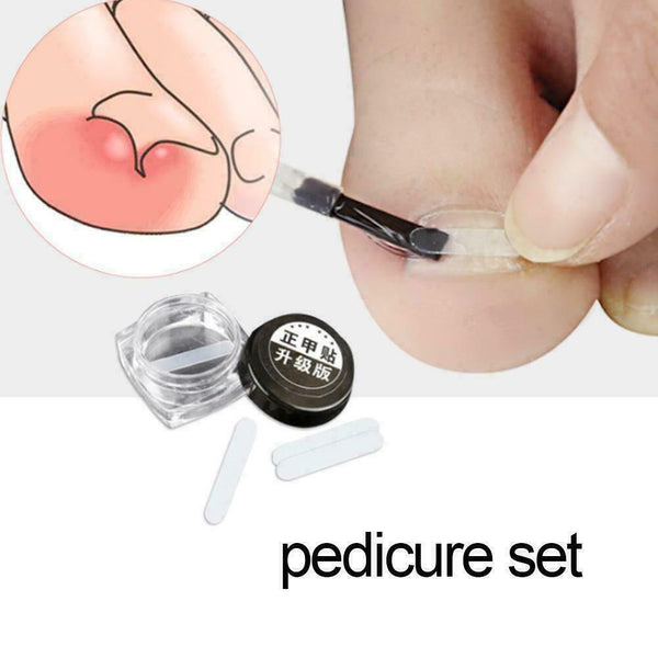 Ingrown Toenail Straightening Clip Glue Correction Curved Hot Brace Kit P3Y8
