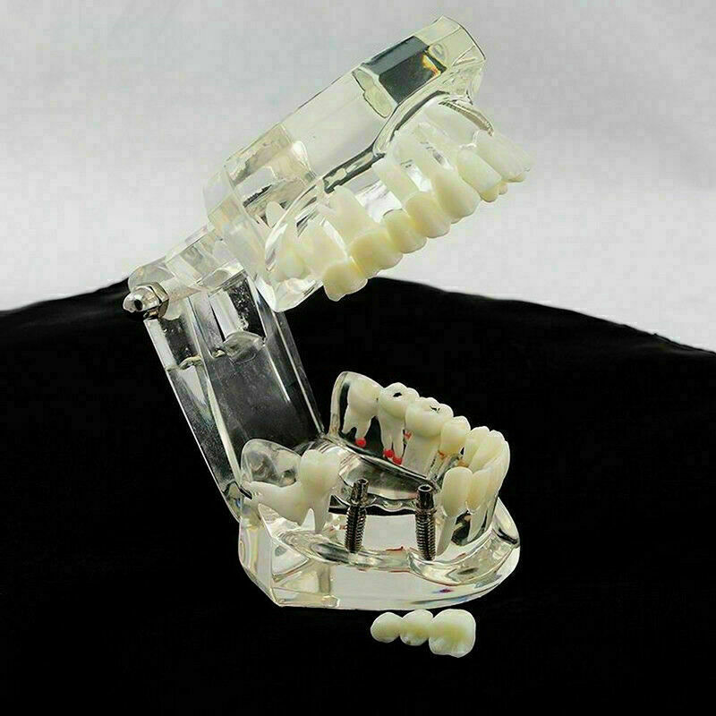 Teeth Restoration Implant Removable Disease Tooth & Teaching Dental Bridge A2X0