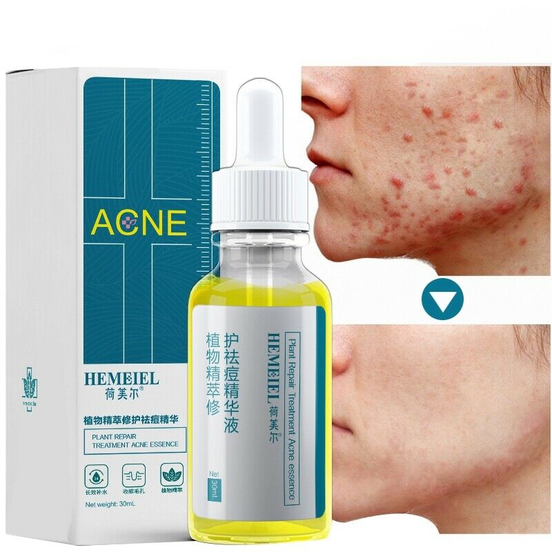 Hemeiel Shrink Pores Serum Acne Treatment Liquid Moisturizing Face Serum An T8W9