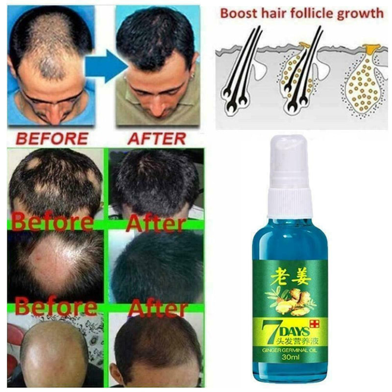 30ML Fast Hair Growth Essence Ginger Liquid Hair Loss Hair Care Treatment I2W8