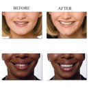 Unique Smile Comfort Fit Flex Cosmetic Denture Snapon Teeth Cosmetic Veneer
