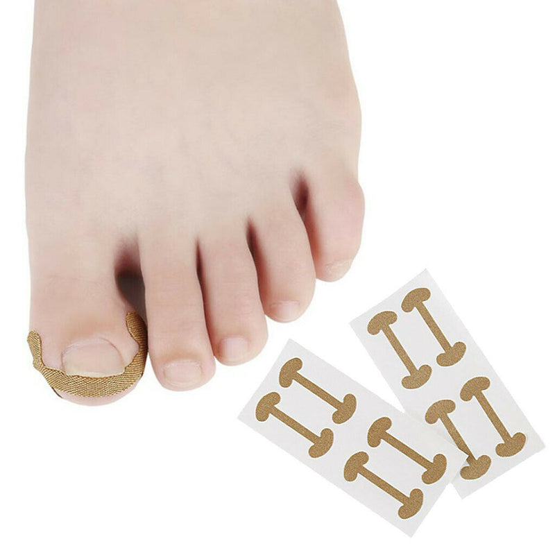 20 Pcs Ingrown Nail Correction Stickers Toenail  Brace Foot Care