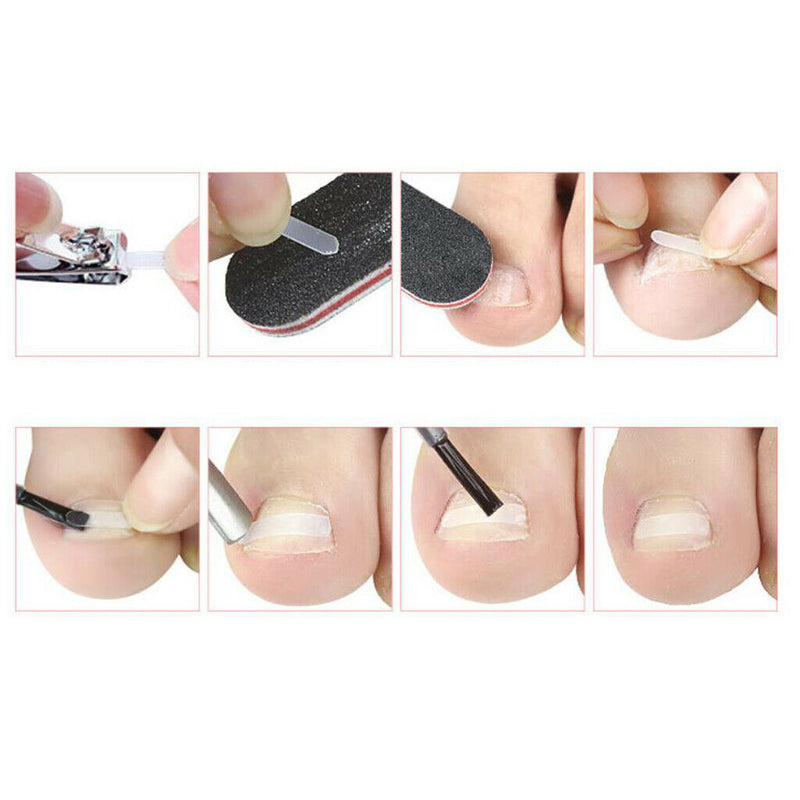 Ingrown Toenail Corrector Patch Brace Treatment Tape w/Pusher Nail File Set