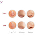 3 PC Women Beauty Pimple Blemish Comedone Acne Needle Extractor Remover Sta