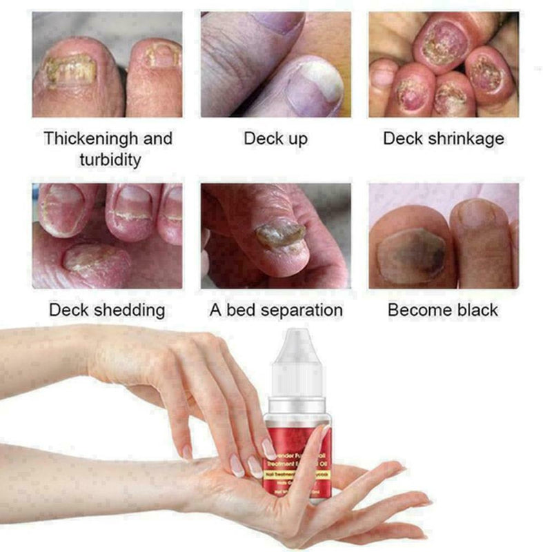 Nail Treatment Essential Oil Nail Nourishing Brightening Promote Nails Foot Y2J3