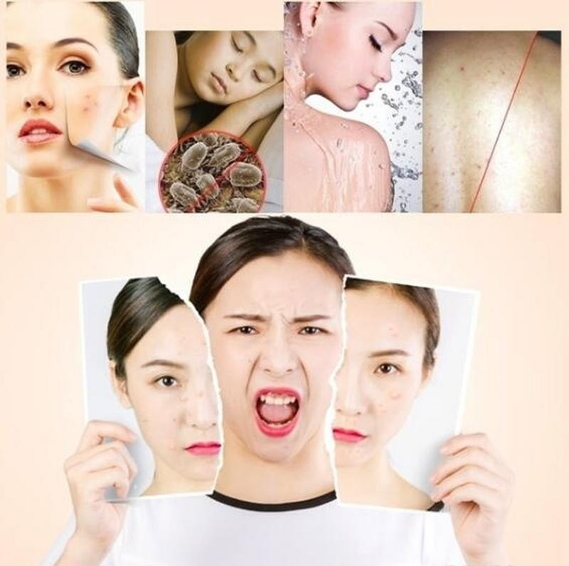 Sulfur Soap Skin Conditions Acne Anti Fungus Handmade Bath Skin Care Shampoo UK