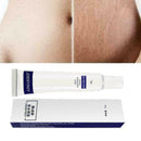 Entfernung Akne Narbe Stretch Marks Creme Fett Narbe Beha Striae Gravidarum Q2M9