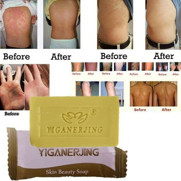 Sulfur Soap Skin Conditions Anti Fungus Bath Whitening Shampoo-Soap CA