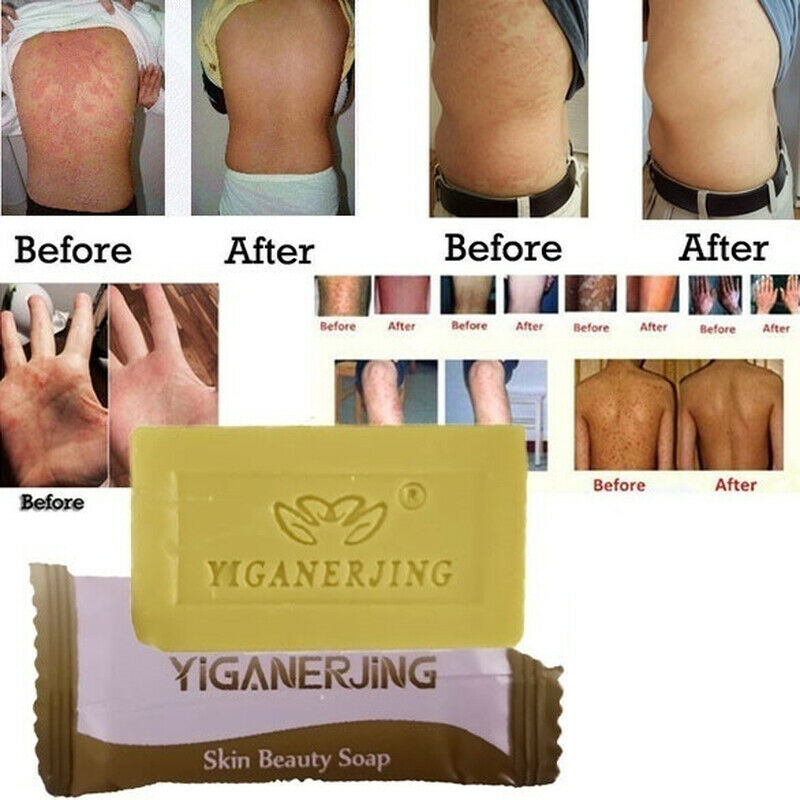 Sulfur Soap Skin Conditions Anti Fungus Bath Whitening Shampoo-Soap CA