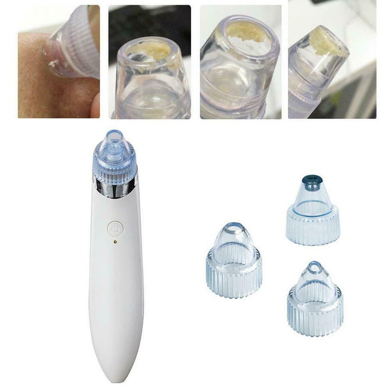 Facial Acne Blackhead Remover Vacuum Suction Pore Clean Machine (White B) SN9F
