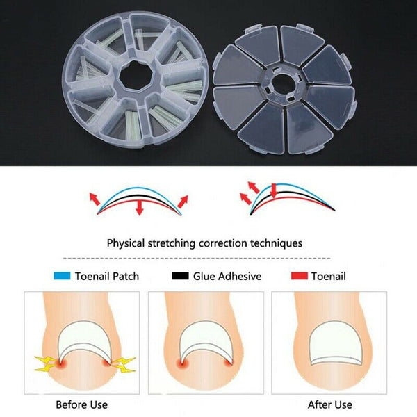 120Pcs/Box Embedded Toenail Correction Stickers Internal Growth Pedicure Tr J8D7