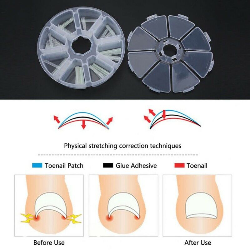 120Pcs/Box Embedded Toenail Correction Stickers Internal Growth Pedicure Tr J8D7