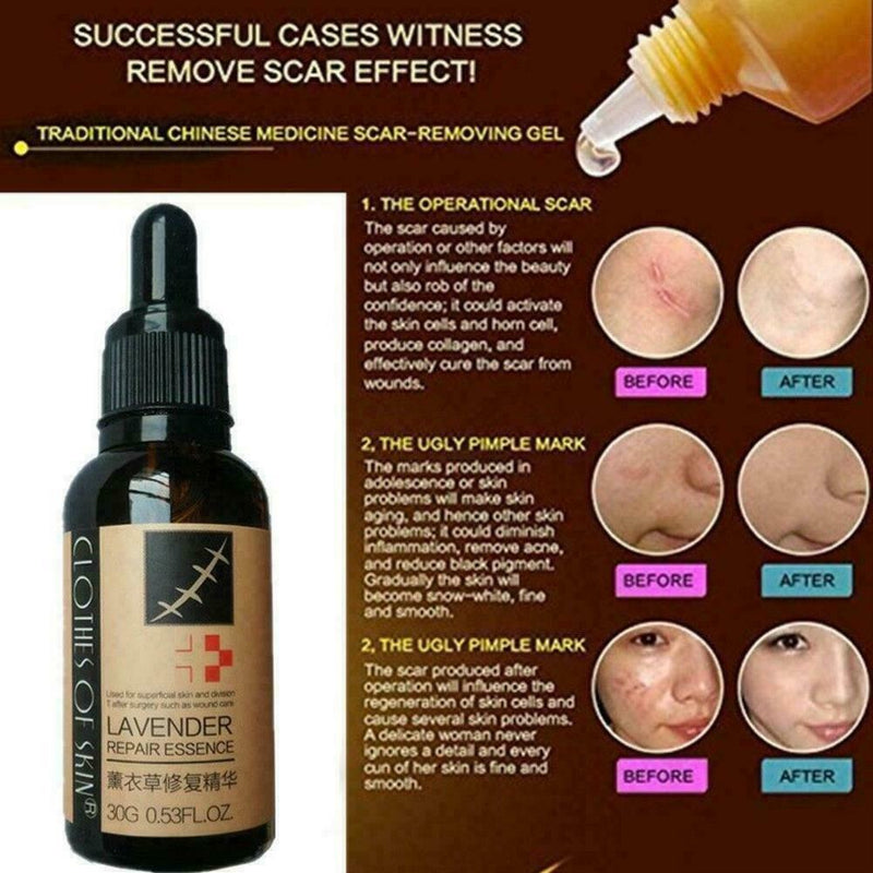 Lavender Essence Skin Care Natural Pure Remove Ance Mark Burn Strentch Remo H0D9