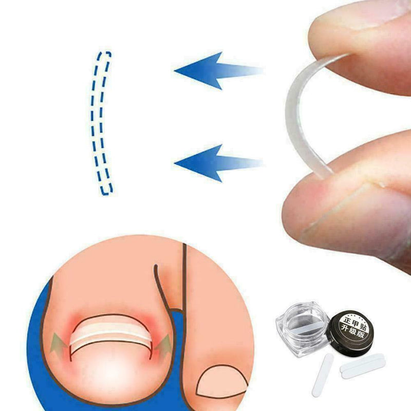 Ingrown Toenail Straightening Clip Glue Correction Curved Hot Brace Kit P3Y8