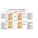 RtopR Propolis Repair Acne Brightening Serum Acne Scar Spots Cleaning Serum U2P3