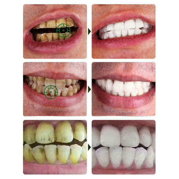 Teeth bright white pen teeth whitening remove plaque stains smoke stains B4 L7V8