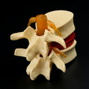 Anatomical Spine Lumbar Disc Herniation Anatomy Medical Teaching Tool