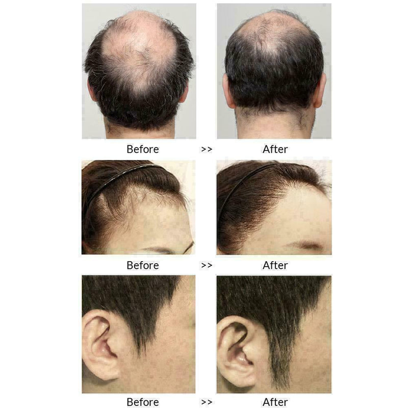 Anti Hair Loss Hair Growth Spray Essential Liquid Dry Repair Regeneration T Z4C9