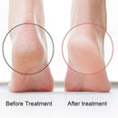 Foot File Foot Rasp Callus Remover With Double Side Scrubs For Your Foot Ca G5Q4