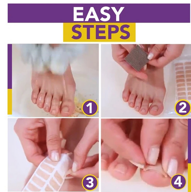 50 sheets Non-Glue Toenail Patch Ingrown Toenail Correction Pedicure Tools