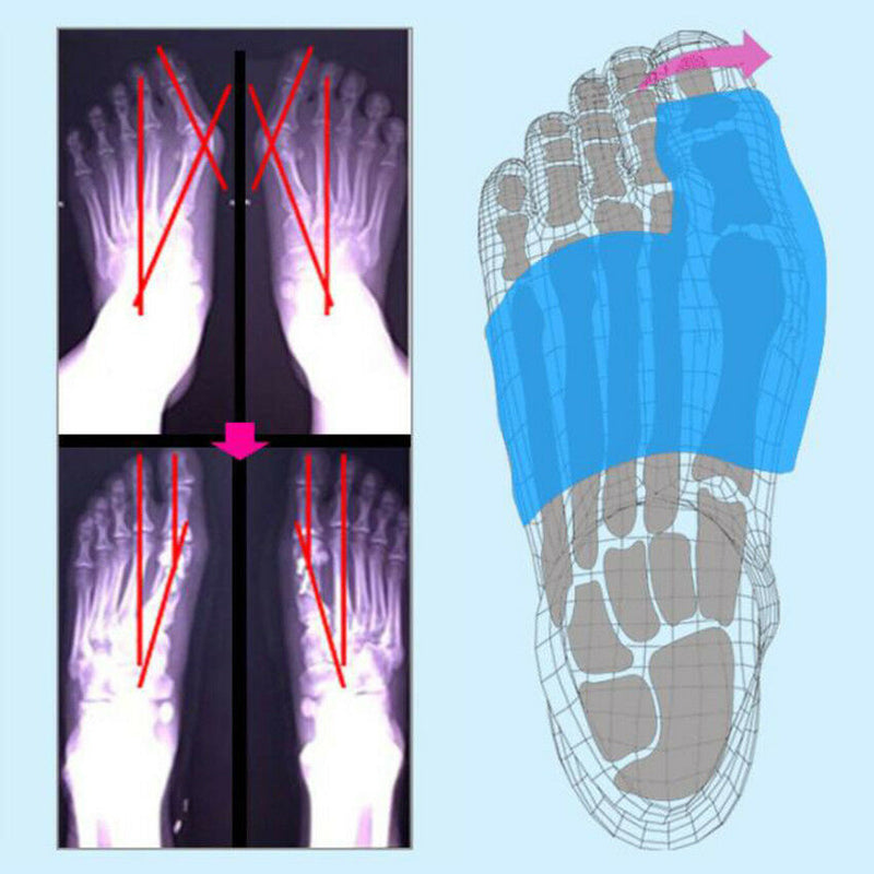 Big Toe Bunion Splint Hallux Valgus Foot Inflatable Corrector Straightener Foot