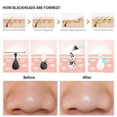 Blackhead Remover Vacuum Peel Tool Extractor Electric Skin Pore Cleaner Pim