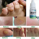 Chicken eye foot pad thorn monkey external use pharmacy delivery batch mixe U4I4