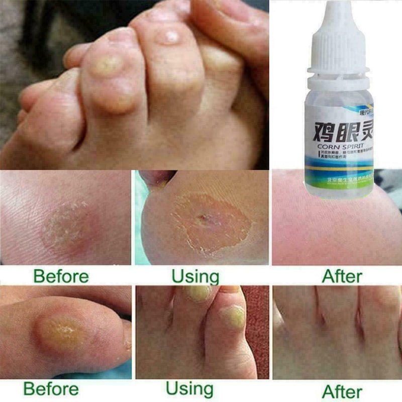 Chicken eye foot pad thorn monkey external use pharmacy delivery batch mixe U4I4