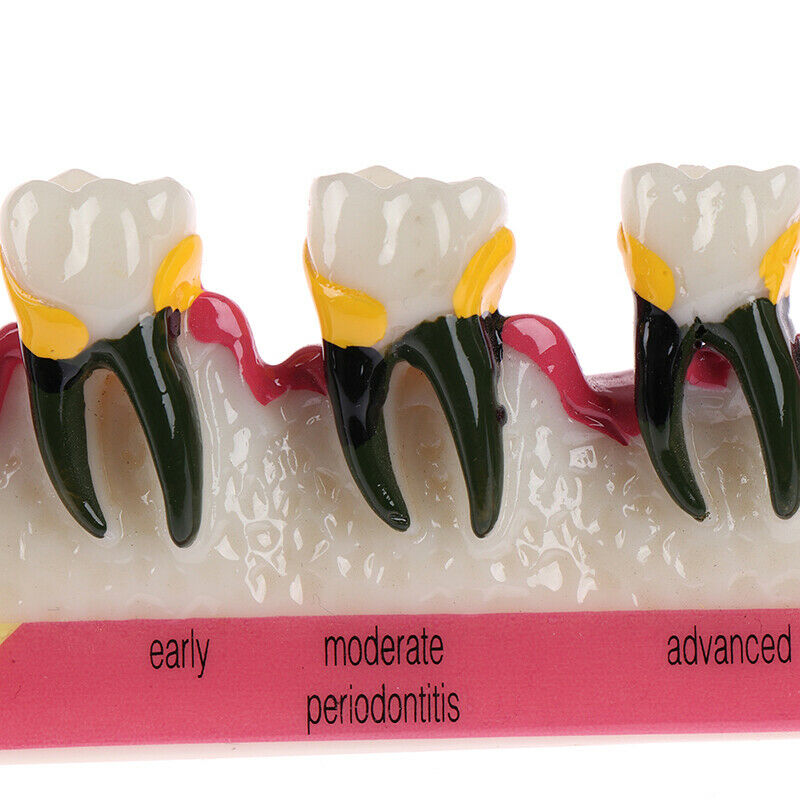 Dental Lab Periodontal Disease Assort Tooth Typodont Study Teaching Teeth ModFT